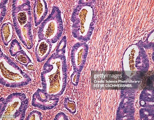 colon cancer, light micrograph - colorectal cancer stockfoto's en -beelden