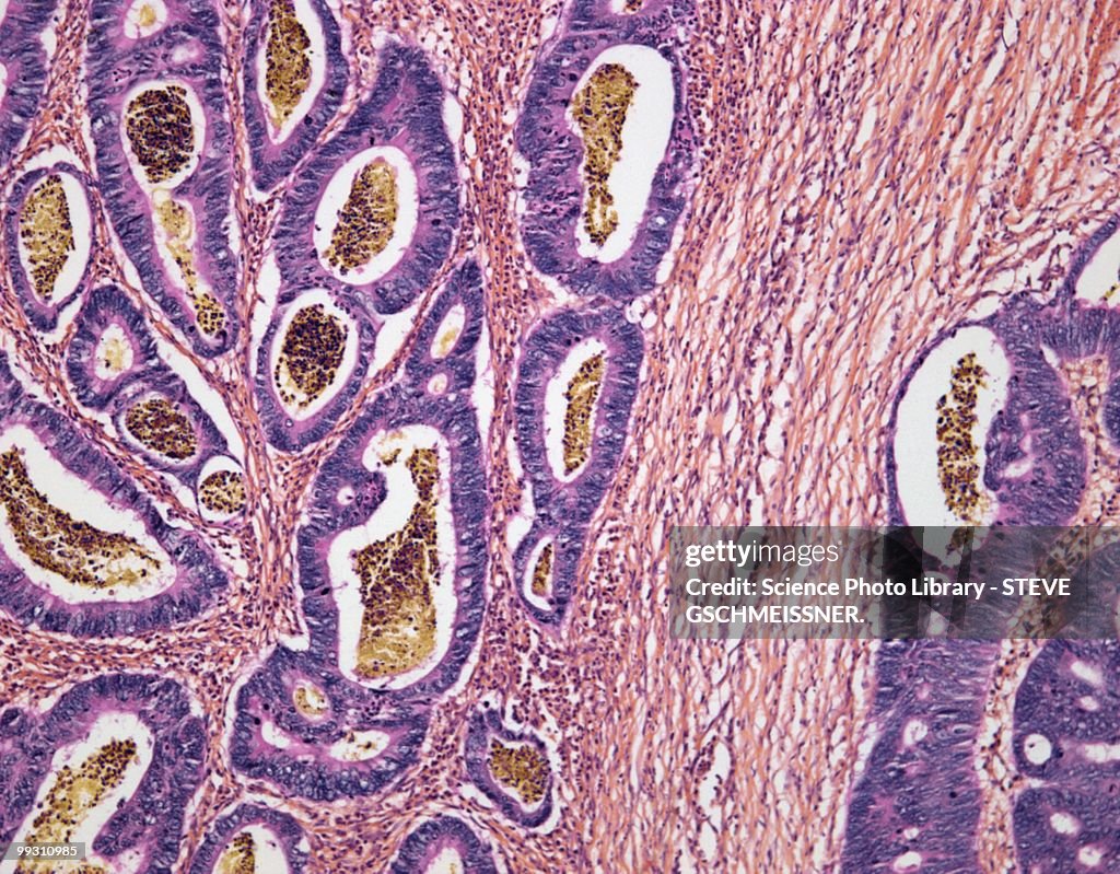 Colon cancer, light micrograph