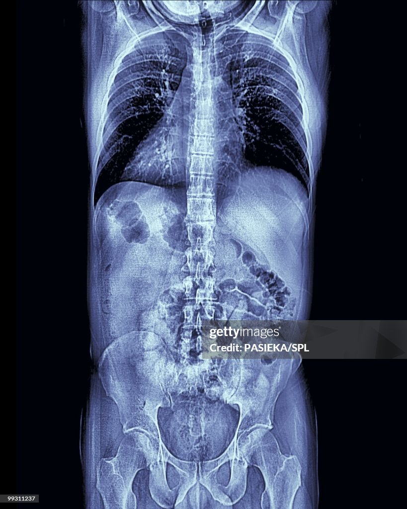 Full Torso Radiography Human Torso Mri Scan High-Res Vector Graphic - Getty Images