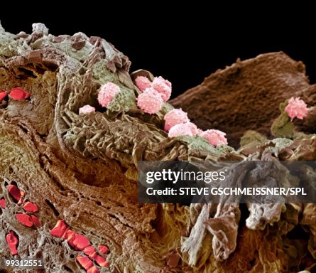 Health Pyoderma Pyoderma Skin Disease Sem High-Res Stock Photo - Getty Images