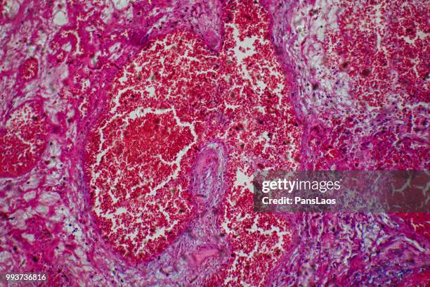 medical hemangioma tumor - microphotographie immunofluorescente photos et images de collection