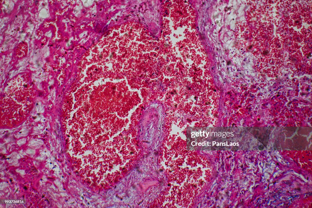 Medical Hemangioma tumor