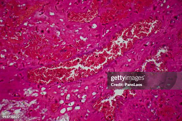 medical hemangioma tumor - hemangioma fotografías e imágenes de stock