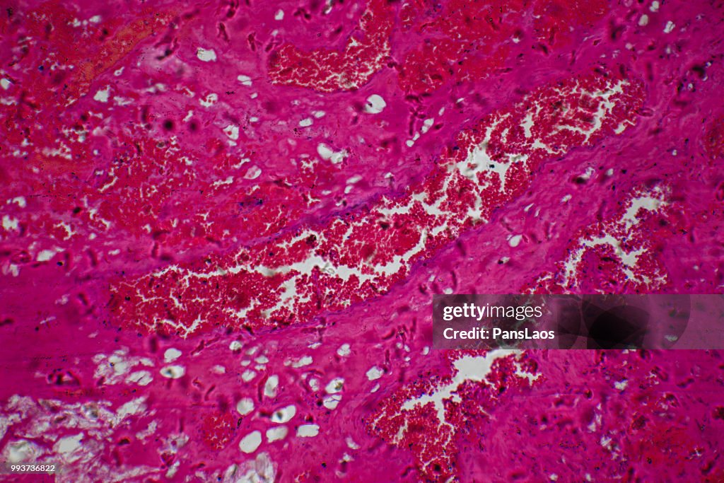 Medical Hemangioma tumor