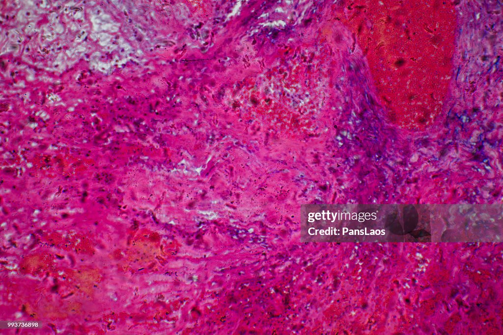 Medical Hemangioma tumor