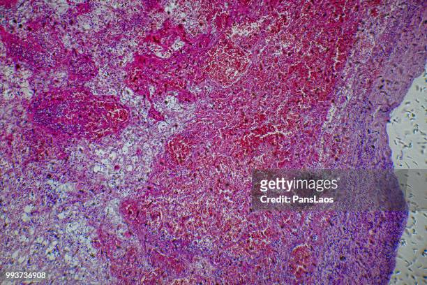 medical hemangioma tumor - microfotografia immunofluorescente foto e immagini stock