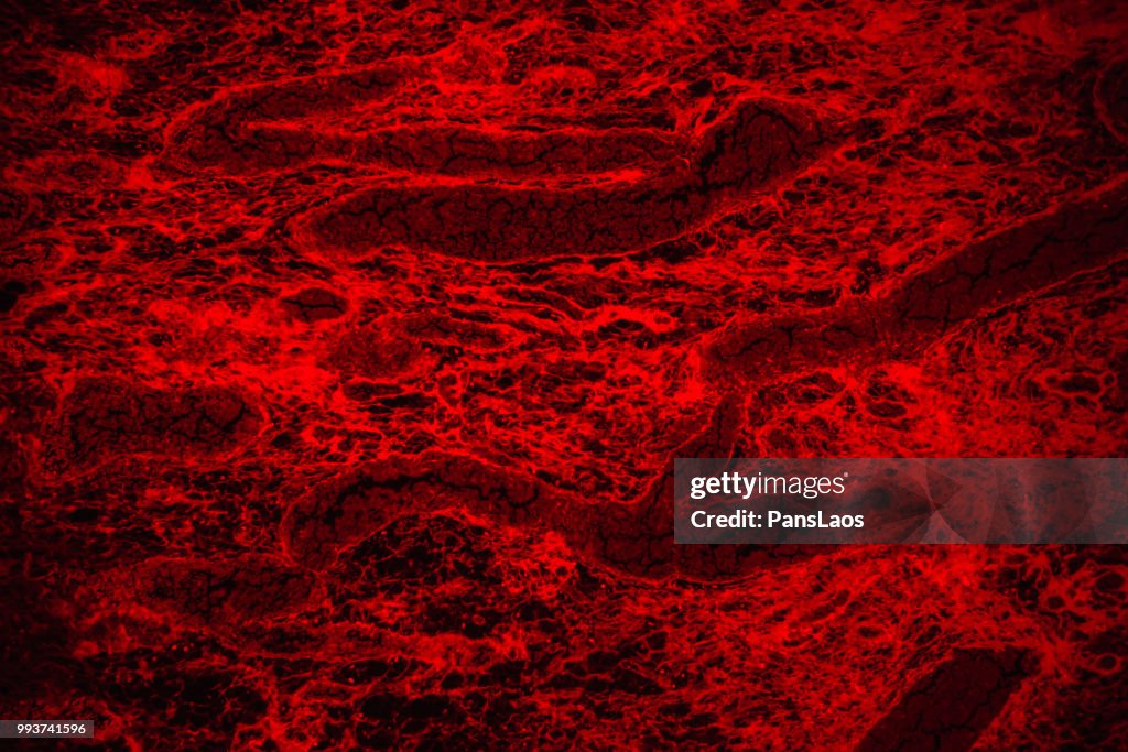 Medical Hemangioma tumor