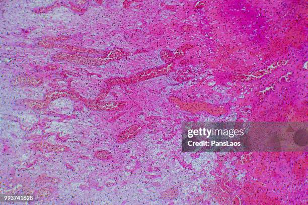 medical hemangioma tumor - microphotographie immunofluorescente photos et images de collection