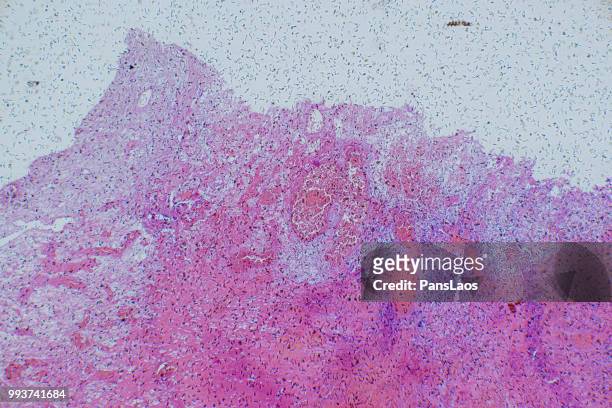 medical hemangioma tumor - microphotographie immunofluorescente photos et images de collection