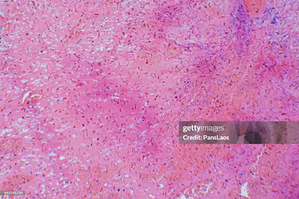 Medical Hemangioma tumor