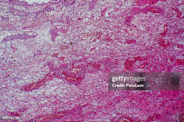 medical hemangioma tumor - microphotographie immunofluorescente photos et images de collection