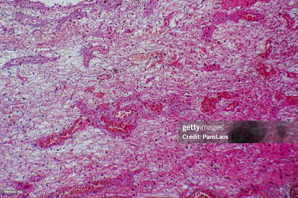 Medical Hemangioma tumor