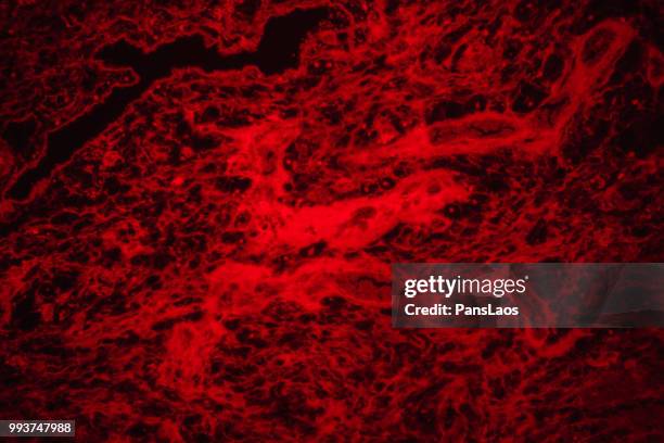 medical hemangioma tumor - hemangioma fotografías e imágenes de stock