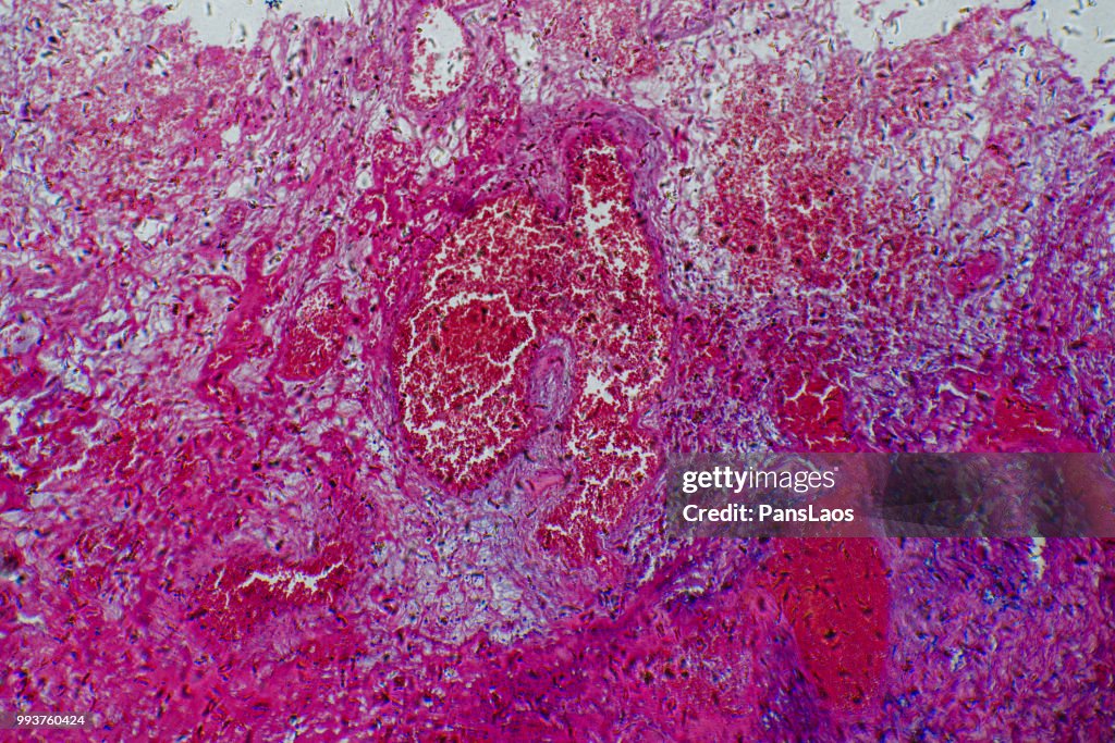 Medical Hemangioma tumor