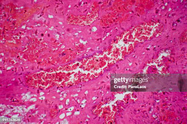 medical hemangioma tumor - fibroblasto imagens e fotografias de stock