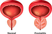 Prostatitis normal and inflamed prostate isolated vector