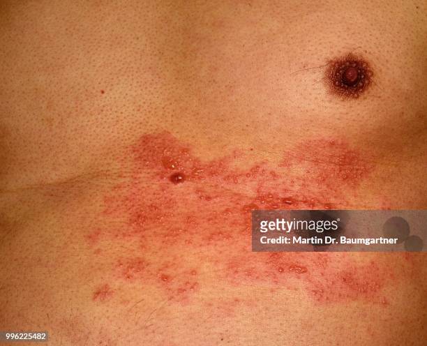 shingles or herpes zoster in the chest area of a man, 56 years, several dermatomes or skin areas affected - chest torso 個照片及圖片檔