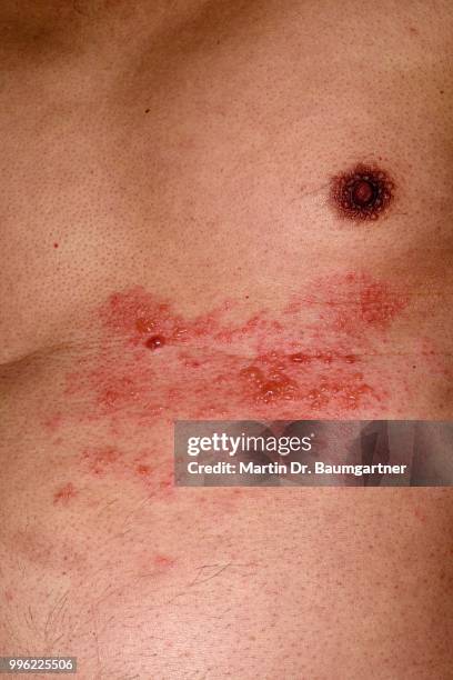shingles or herpes zoster in the chest area of a man, 56 years, several dermatomes or skin areas affected - herpes zoster fotografías e imágenes de stock