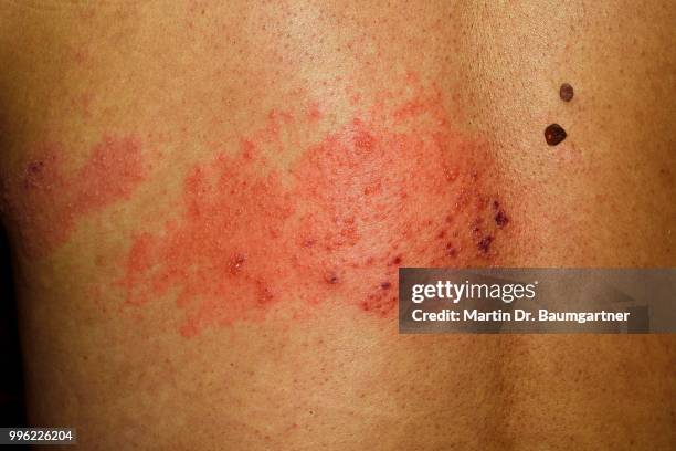 shingles or herpes zoster, with secondary finding of dysplastic nevi, atypical moles, man, 56 years - herpes zoster stock pictures, royalty-free photos & images