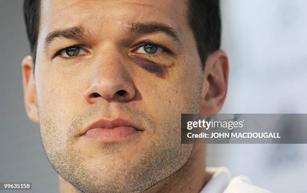 Picture taken on March 2, 2010 shows Germany's midfielder Michael Ballack sporting a black eye as he addresses a press conference in the southern...