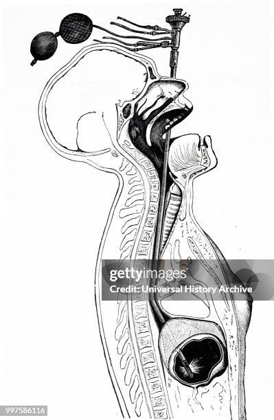 Engraving depicting an early gastroscope by Leitner of Vienna. Prisms at the bend enabled the stomach to be observed. It contained a fine channel...