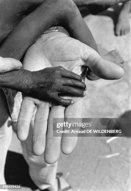 Main d'un enfant famélique en Ouganda en aout 1980.