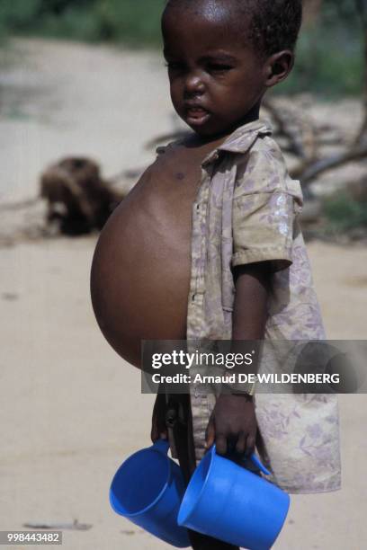 Enfant souffrant de malnutrition, mai 1981 en Somalie.