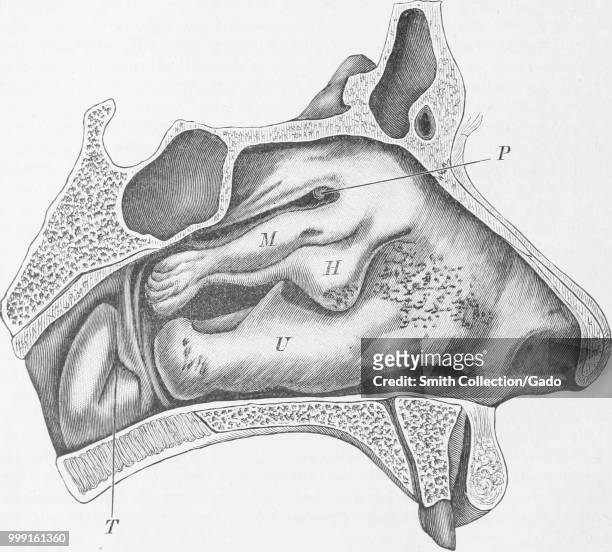 Black and white print depicting a left nasal cavity, with lumpy hyperplasia of the mucous membrane toward the anterior end of the middle turbinate...