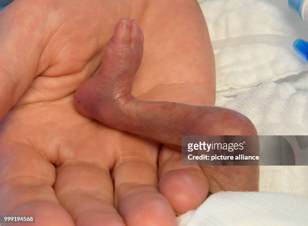 The right foot of a 5-day-old boy who weighed 430 grams at birth, in the hand of a nurse, at the children's clinic of Hannover Medical School in...