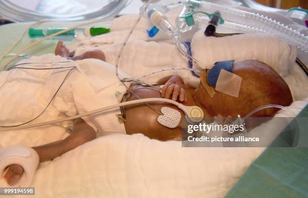 Day-old boy who weighed 430 grams at birth, in an incubator at the children's clinic of Hannover Medical School in Hanover, Germany, 11 August 2017....