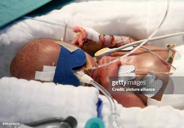 Day-old boy who weighed 430 grams at birth, in an incubator at the children's clinic of Hannover Medical School in Hanover, Germany, 11 August 2017....