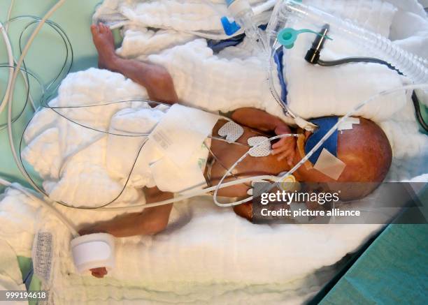 Day-old boy who weighed 430 grams at birth, in an incubator at the children's clinic of Hannover Medical School in Hanover, Germany, 11 August 2017....