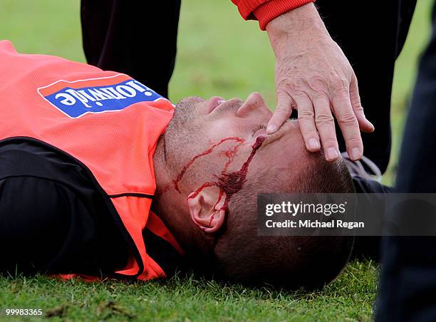 Matthew Upson is treated for a cut to the head during an England training session on May 19, 2010 in Irdning, Austria.