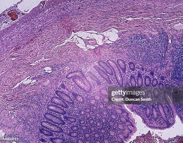 microscopic image of an inflamed appendix - sterk-uitvergroot stockfoto's en -beelden