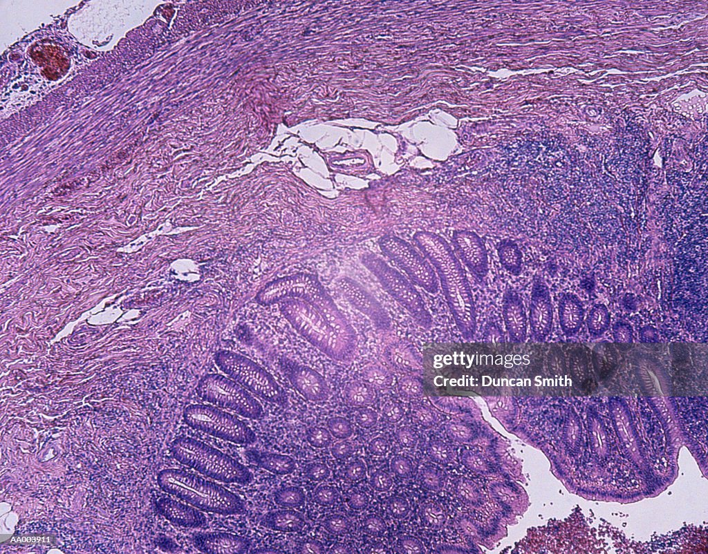 Microscopic Image Of An Inflamed Appendix High-Res Stock Photo - Getty ...