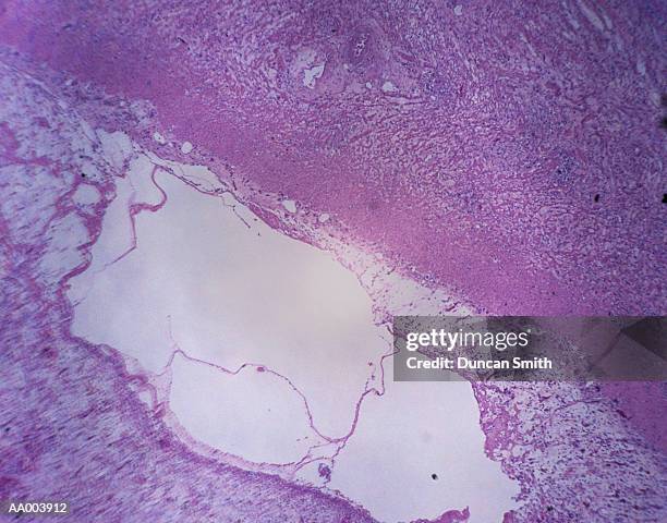 microscopic image of a gastric ulcer - sterk-uitvergroot stockfoto's en -beelden