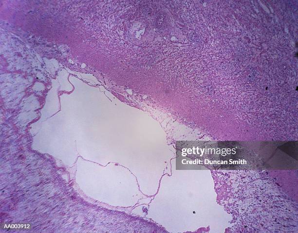 microscopic image of a gastric ulcer - gastric ulcer 個照片及圖片檔