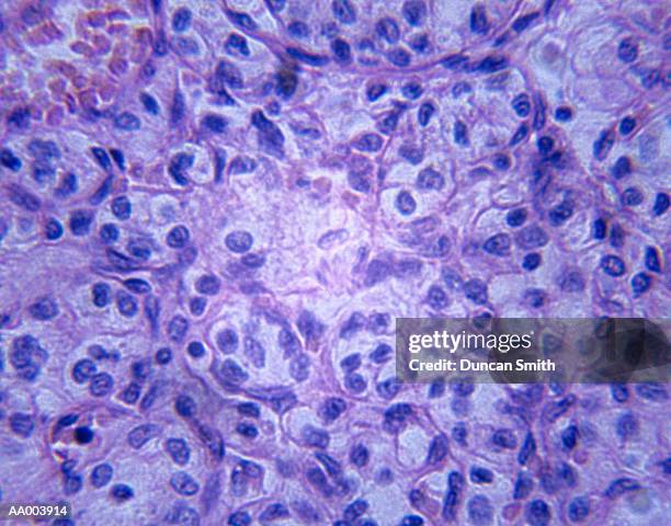 microscopic image of kidney carcinoma - alta magnificação - fotografias e filmes do acervo