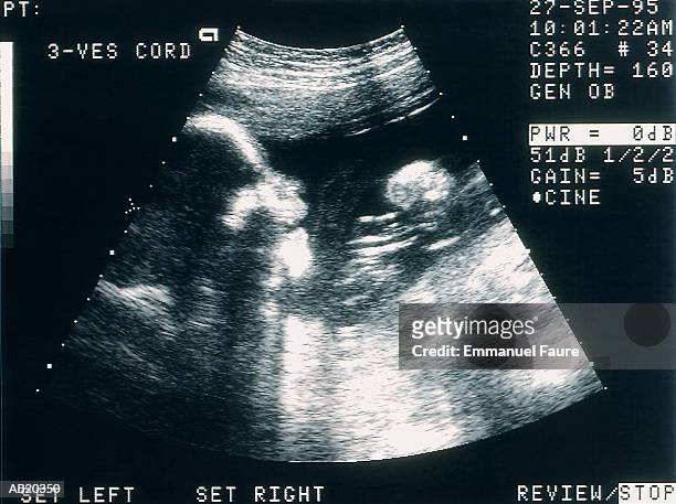 sonogram of human fetus (b&w) - ultrasound scan - fotografias e filmes do acervo