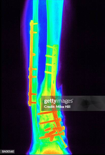 x-ray of human leg showing repaired tibia and fibula (colored) - fibula foto e immagini stock