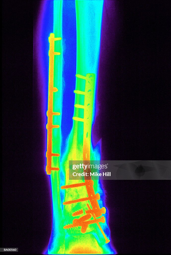 X-ray of human leg showing repaired tibia and fibula (colored)