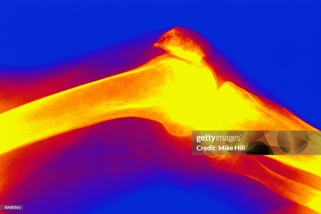 X-ray of human knee (patella) (digital enhancement)