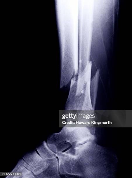 x-ray of broken tibia and fibula - fibula stockfoto's en -beelden