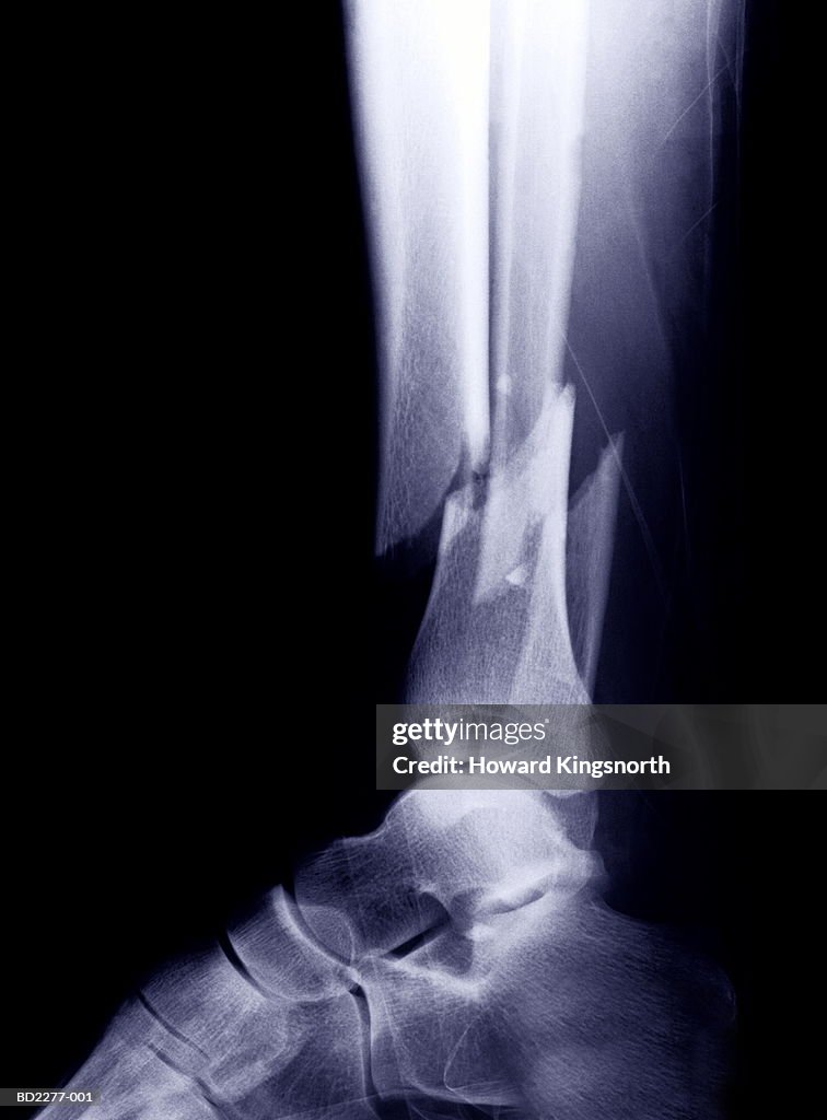X-ray of broken tibia and fibula