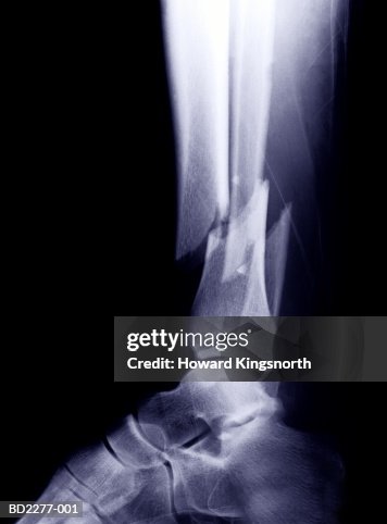 Tibia And Fibula X Ray