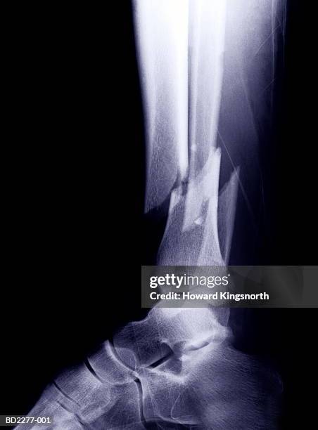 x-ray of broken tibia and fibula - fibula stock pictures, royalty-free photos & images