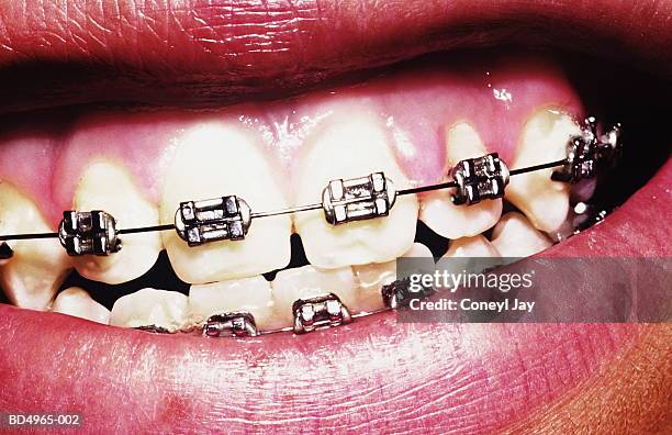 teenage girl (14-16) with braces on teeth, close-up of mouth - braces fotografías e imágenes de stock