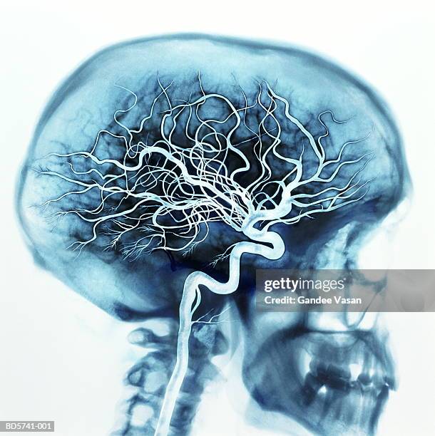 x-ray of skull showing arteries in brain (digital enhancement) - x ray image fotografías e imágenes de stock