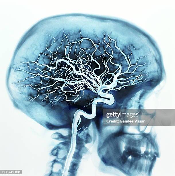 x-ray of skull showing arteries in brain (digital enhancement) - skull xray no brain stock pictures, royalty-free photos & images