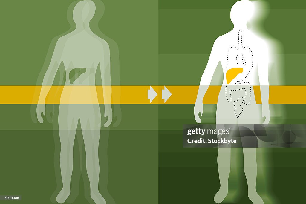 Liver transplant